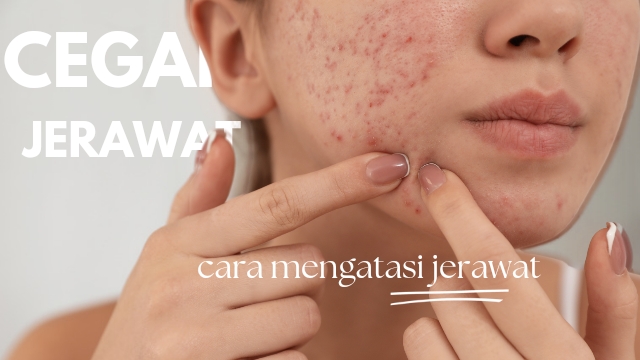 Kebiasaan Sehari Hari Penyebab Jerawat Mengungkap Pemicu Tersembunyi Di Balik Kulit Bersih
